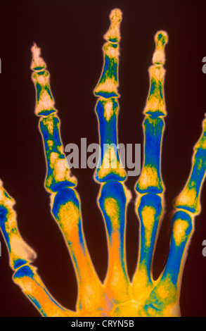 HYPERPARATHYROIDISM, X-RAY Stock Photo: 49167076 - Alamy