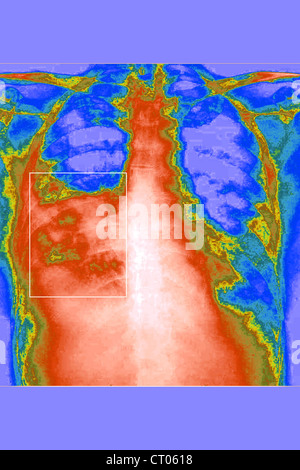 PNEUMONIA, PNEUMOCYSTIS CARINII Stock Photo