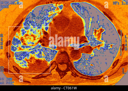 PNEUMONIA, PNEUMOCYSTIS CARINII Stock Photo