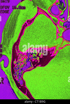 INTERNAL EAR, MRI Stock Photo: 49203304 - Alamy