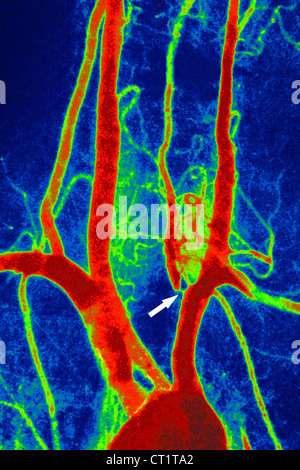 STENOSIS OF VERTEBRAL ARTERY Stock Photo