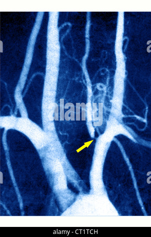 STENOSIS OF VERTEBRAL ARTERY Stock Photo