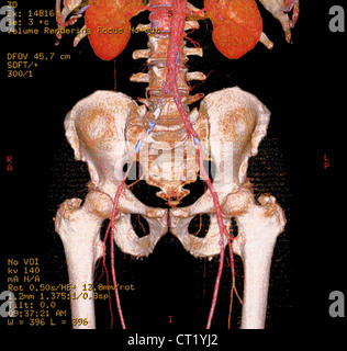 ILIAC THROMBOSIS, 3D SCAN Stock Photo