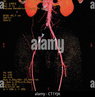 ILIAC THROMBOSIS, 3D SCAN Stock Photo