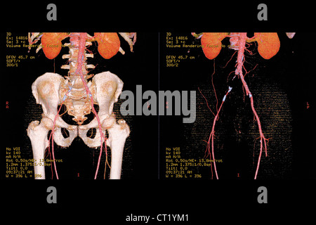 ILIAC THROMBOSIS, 3D SCAN Stock Photo