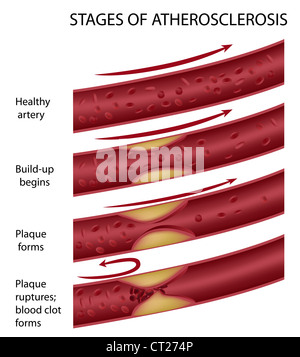 Atherosclerosis stages, illustration Stock Photo - Alamy
