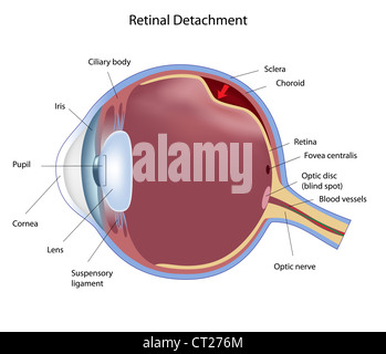 Eye disease retinal detachment Stock Photo