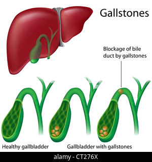 Illustration of Human gallbladder and gallstones anatomy Stock Vector ...