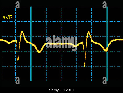 RIGHT BUNDLE-BRANCH BLOCK, ECG Stock Photo