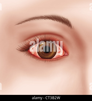 CHEMOSIS Stock Photo: 49156953 - Alamy