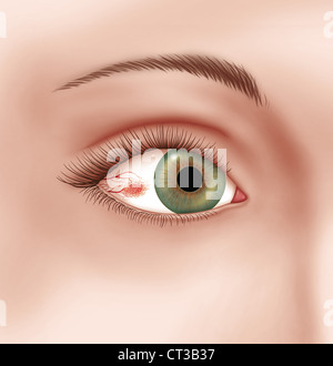 EPISCLERITIS, ILLUSTRATION Stock Photo: 49247081 - Alamy