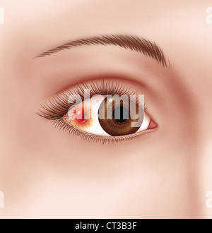 Nodular Scleritis, Drawing Stock Photo - Alamy