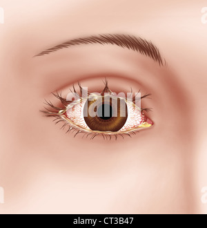 Human eye disease with viral conjunctivitis illustration Stock Vector ...