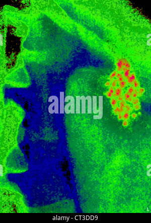 GALLSTONE, X-RAY Stock Photo