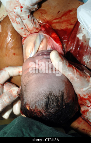 A baby being born. Caesarean Stock Photo