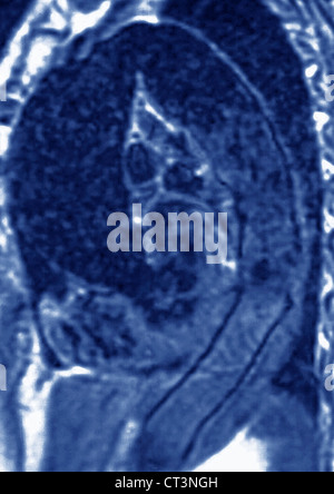 AORTIC DISSECTION, MRI Stock Photo - Alamy