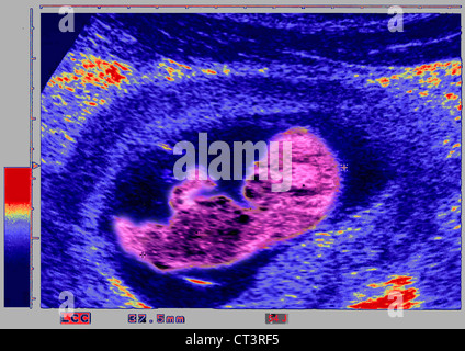 Ultrasound photography hi-res stock photography and images - Page 3 - Alamy