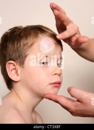 CHILD WITH HEMATOMA Stock Photo