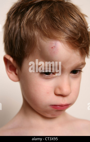 CHILD WITH HEMATOMA Stock Photo