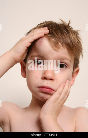 CHILD WITH HEMATOMA Stock Photo