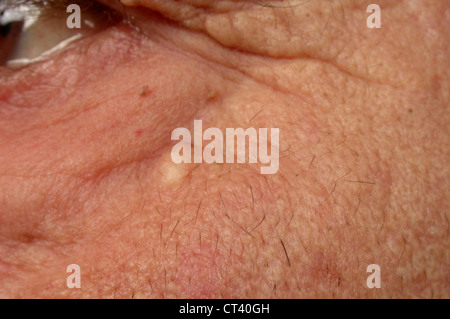 SEBACEOUS CYST Stock Photo, Royalty Free Image: 49260755 - Alamy