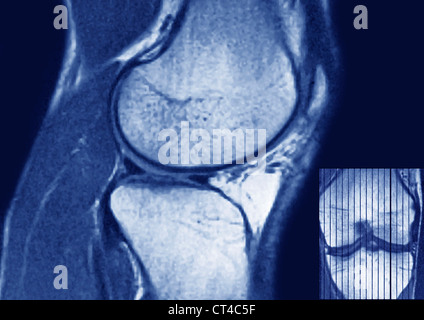 mri knee Stock Photo - Alamy