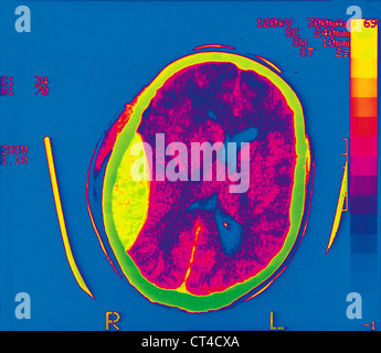 HEMATOMA, BRAIN SCAN Stock Photo