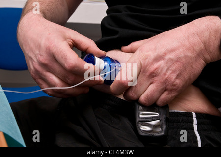 EXTERNAL INSULIN PUMP Stock Photo