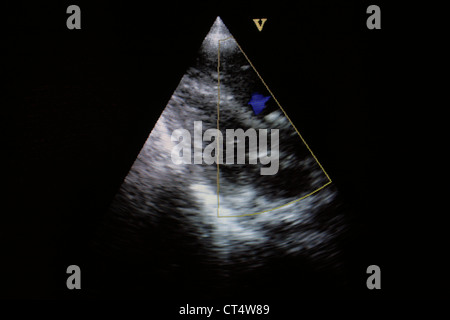 HEART, SONOGRAPHY RESULT Stock Photo