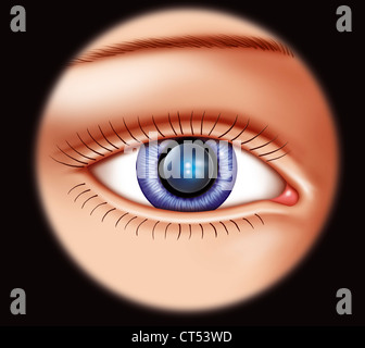achroma intraocular lens