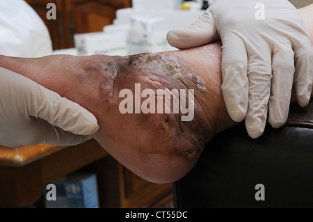 HYPERKERATOSIS Stock Photo