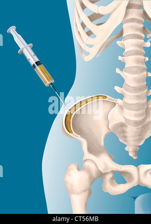 BONE MARROW ASPIRATION Stock Photo Alamy   Bone Marrow Aspiration Ct56mb 