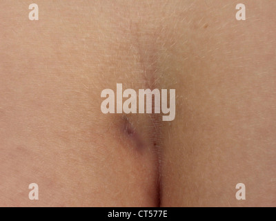 Pilonidal cyst on a man's buttocks - Stock Image - C058/5133 - Science  Photo Library