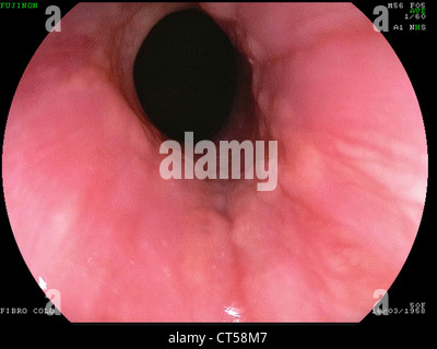 ESOPHAGUS Stock Photo: 48423778 - Alamy