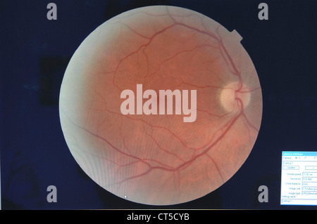 FUNDUS OCULI RESULT Stock Photo