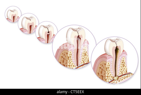 DENTAL CARIE, DRAWING Stock Photo - Alamy