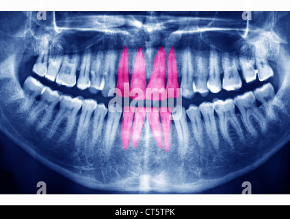 DENTAL X-RAY RESULT Stock Photo