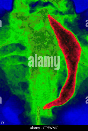 UTERINE FIBROMA, X-RAY Stock Photo