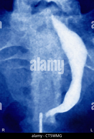 UTERINE FIBROMA, X-RAY Stock Photo