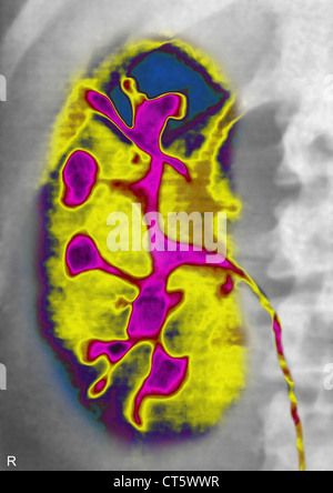 POLYCYSTIC KIDNEY DISEASE, X-RAY Stock Photo