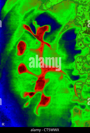 POLYCYSTIC KIDNEY DISEASE, X-RAY Stock Photo