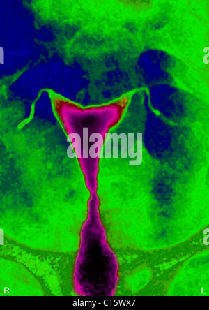 The hysterosalpingography or hysterography is an X-ray of the uterus ...