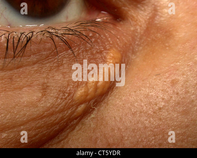 XANTHELASMA Stock Photo