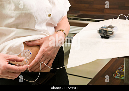 EXTERNAL INSULIN PUMP Stock Photo