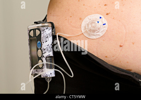 EXTERNAL INSULIN PUMP Stock Photo