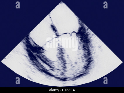 HEART, SONOGRAPHY RESULT Stock Photo