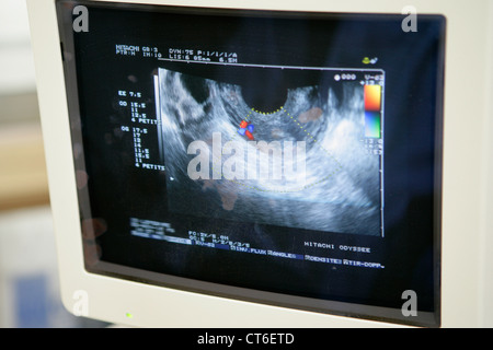 TRANSVAGINAL ULTRASOUND Stock Photo