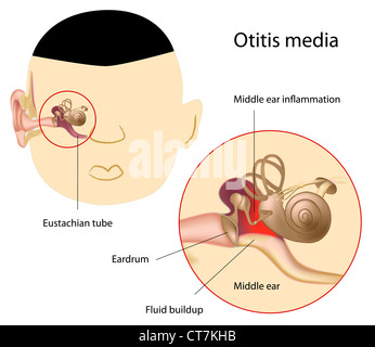 Otitis media Stock Photo