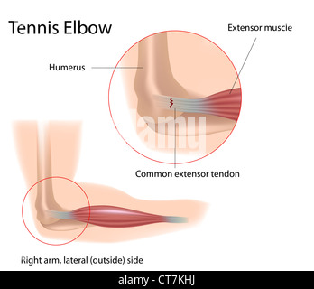 Tennis elbow Stock Photo