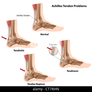 Achilles tendon problems Stock Photo